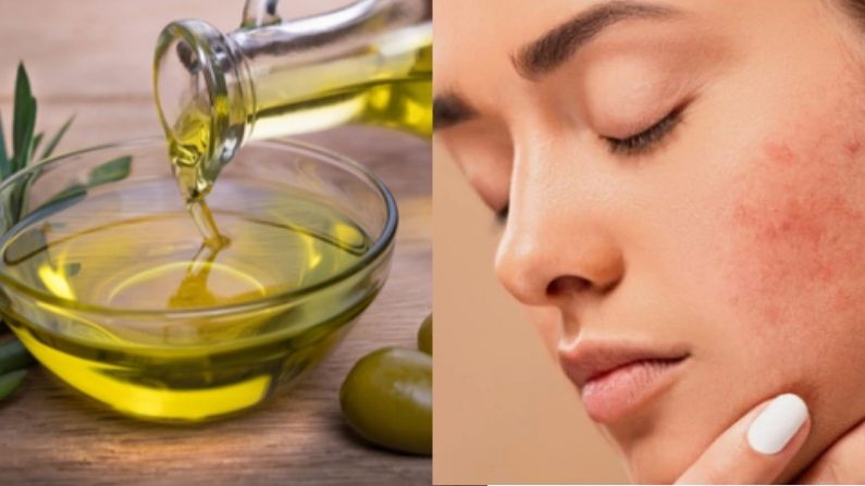 Dùng dầu olive không đúng cách dễ gây nổi mụn