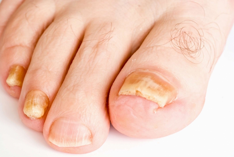 Móng chân màu vàng và dày là dấu hiệu của bệnh nấm móng