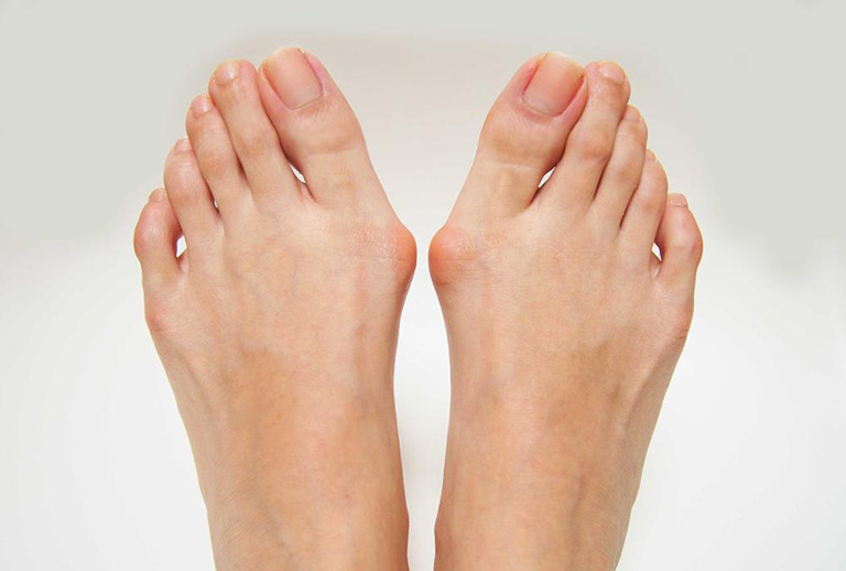 Xuất hiện tình trạng sưng, đau, đỏ ở các ngon chân thì khả năng cao bạn đã bị bệnh gout