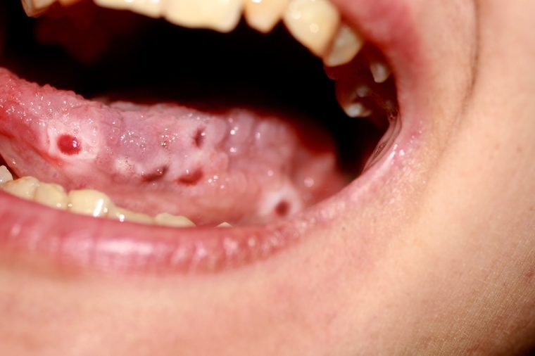 Lưỡi bị lở loét là một trong những dấu hiệu của bệnh ung thư lưỡi