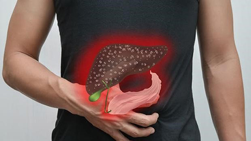 Người bị sỏi đường mật trong và ngoài gan có thể được cân nhắc mở ống mật chủ lấy sỏi