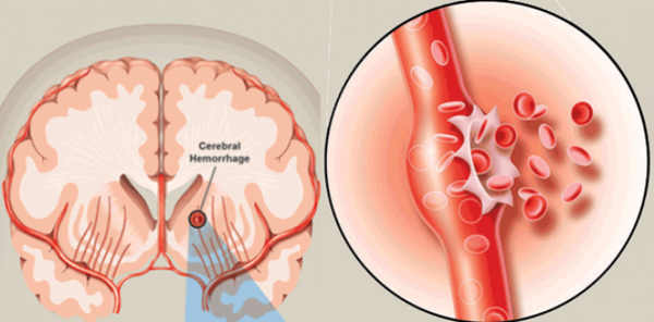  Xuất huyết não xảy ra khi mạch máu não có hiện tượng rỉ hoặc vỡ làm máu chảy ra bên ngoài