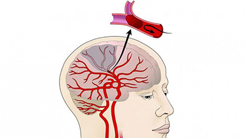 Người bệnh tai biến mạch máu não do thiếu máu cục bộ cần được tái thông mạch máu kịp thời