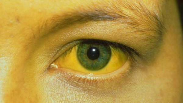 Người bệnh Ung thư gan nguyên phát bị vàng da, vàng mắt