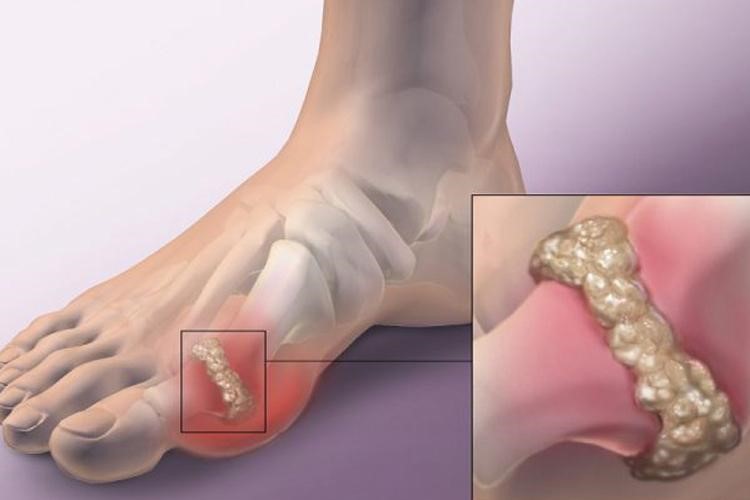Các tinh thể urat lắng đọng tại các khớp ngón chân gây đau dữ dội