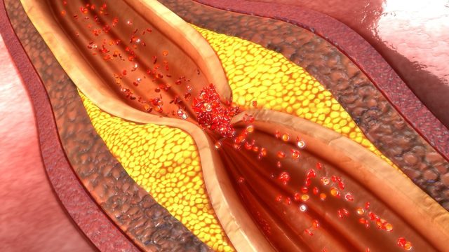 Xơ vữa động mạch, bệnh mạch vành có thể góp phần gây suy tim
