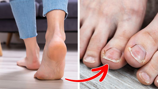 Móng chân chuyển màu vàng, giòn và dễ tổn thương là một trong những tác hại khi bạn đi chân trần trong nhà