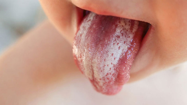 Mảng trắng trên lưỡi có thể là triệu chứng của bệnh tưa miệng do nhiễm nấm