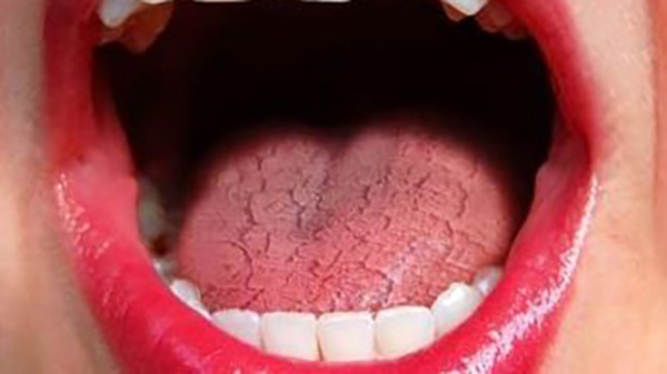Các vết nứt trên lưỡi thường là vô hại nhưng nếu vệ sinh răng miệng kém sẽ dễ bị nhiễm nấm