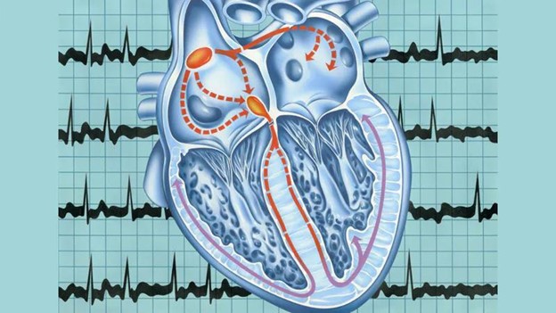 Rung nhĩ có thể làm tăng nguy cơ hình thành cục máu đông gây đau tim, đột quỵ