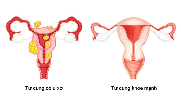 U xơ tử cung thường gặp ở phụ nữ trong độ tuổi sinh sản