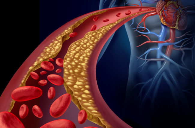 Xơ vữa động mạch có liên quan tới nhiều bệnh lý tim mạch như rối loạn nhịp tim