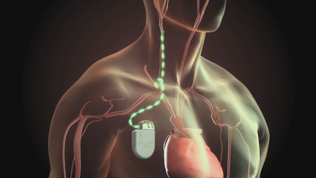 Người bệnh có thể cần cấy ghép các thiết bị hỗ trợ trong giai đoạn C của bệnh suy tim