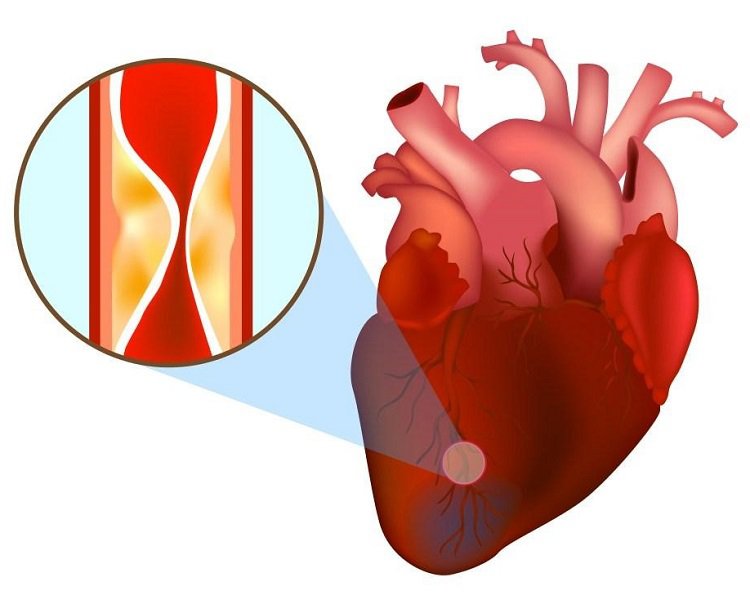 Xơ vữa động mạch vành làm trầm trọng thêm các biến chứng do rối loạn nhịp tim