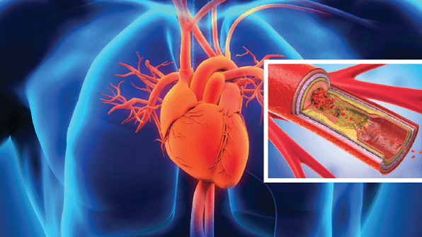 Suy tim bên phải có thể xảy ra do tăng áp động mạch phổi, dị tật tim bẩm sinh...