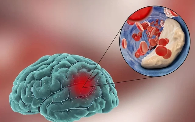 Nhồi máu não do sự tắc nghẽn các mạch máu gây ra
