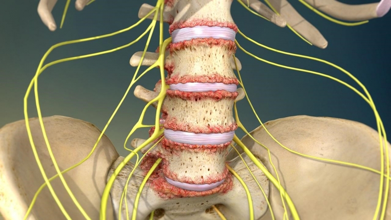 Thoái hóa cột sống là nguyên nhân hàng đầu gây đau lưng