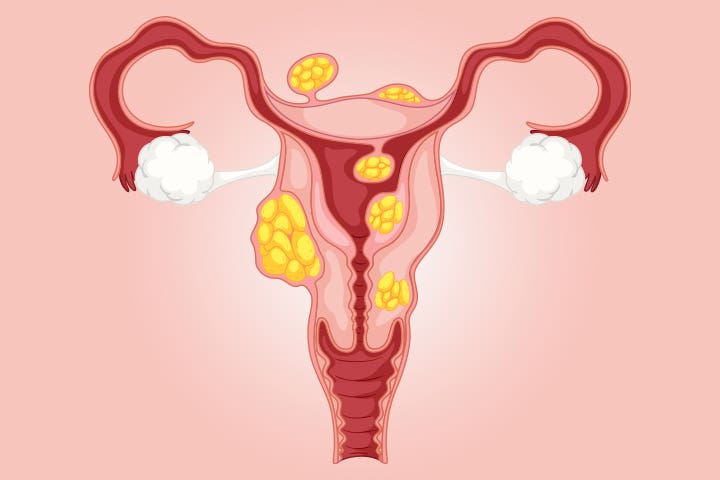 Khối u xơ có thể xuất hiện ở nhiều vị trí trong tử cung