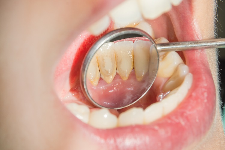Cao răng là nguyên nhân chính gây ra các vấn đề về răng miệng như hôi miệng