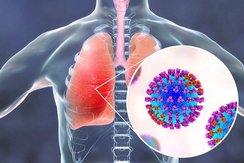 Xơ phổi là một biến chứng nguy hiểm hậu COVID-19