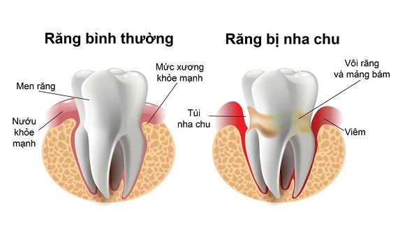 Viêm nha chu không điều trị kịp thời có thể gây thoái hóa các tổ chức quanh răng