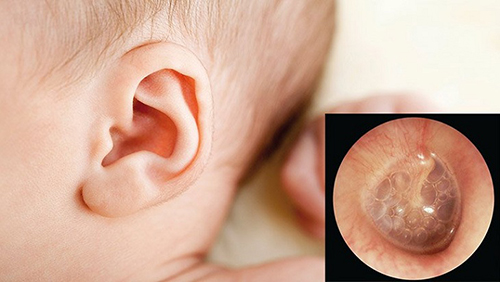 Viêm tai giữa cấp là biến chứng điển hình của bệnh sởi