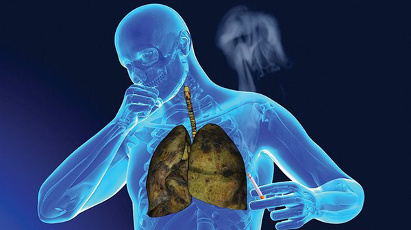 Hút thuốc lá là thủ phạm chính gây bệnh ung thư phổi