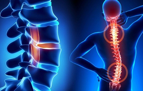 Chứng đau cột sống do biến chứng loạn dưỡng xương ở người bệnh suy thận