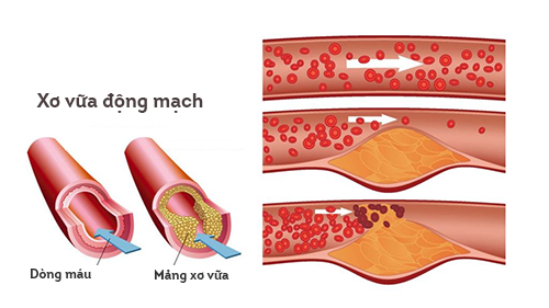 Xơ vữa động mạch có liên hệ mật thiết với tình trạng tăng huyết áp