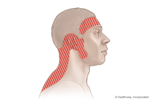 Cơn đau xuất hiện ở các vị trí trên có thể cảnh báo cơn đau đầu căng cơ
