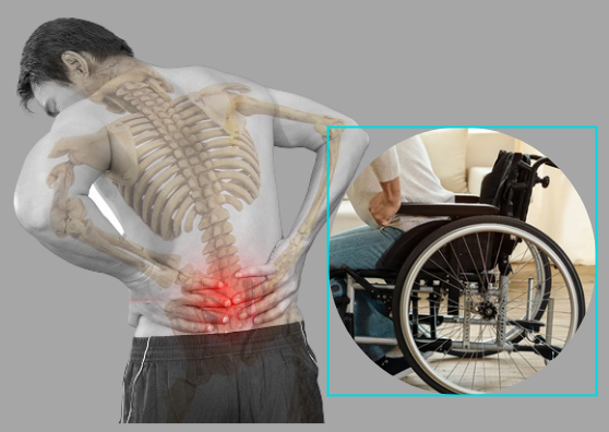 Thoái hóa cột sống thắt lưng có thể gây hạn chế hoặc mất khả năng vận động