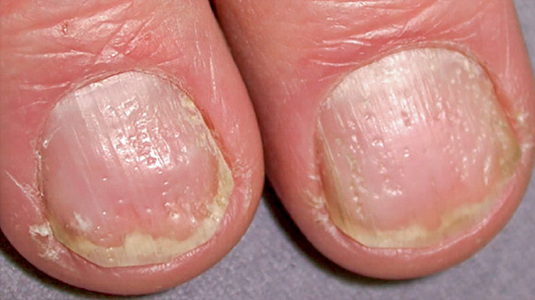 Các lỗ nhỏ trên móng tay là triệu chứng điển hình của vảy nến móng tay