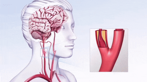 Xơ vữa động mạch có mối liên hệ chặt chẽ với cơn thiếu máu não thoáng qua