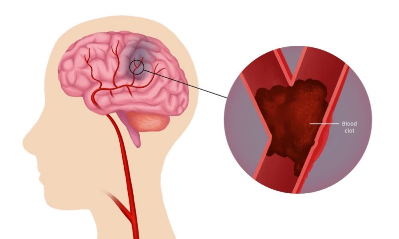 Cục máu đông làm tắc nghẽn mạch máu lưu thông tới một vùng não