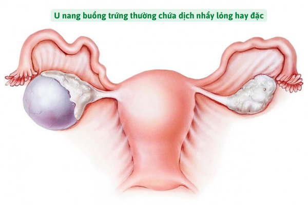 Khối u xuất hiện ở buồng trứng có thể ảnh hưởng tới các cơ quan xung quanh