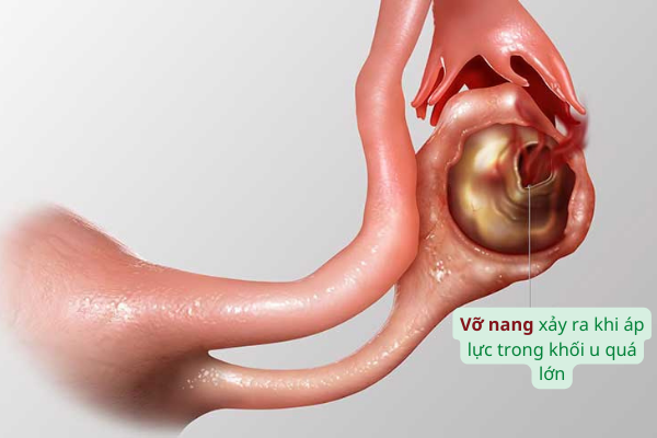 Vỡ u nang buồng trứng có thể gây nhiễm khuẩn, đe dọa đến tính mạng người bệnh