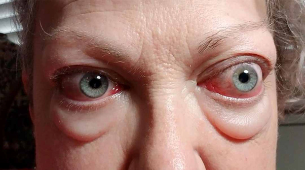 Lồi mắt là biểu hiện thường gặp của bệnh cường giáp Basedow