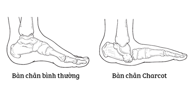 Hình ảnh bàn chân Charcot ở người bệnh đái tháo đường (ảnh bên phải)