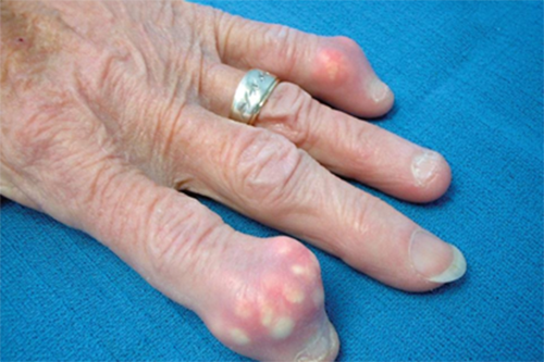 Hạt tophi tích tụ tại các đốt ngón tay gây đau nhức nghiêm trọng