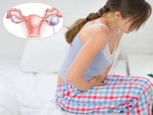 Đau bụng là triệu chứng thường gặp khi mắc u nang buồng trứng 
