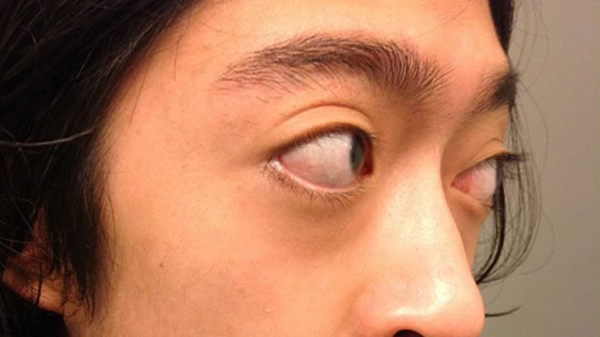 Lồi mắt là một triệu chứng điểm hình của bệnh Basedow