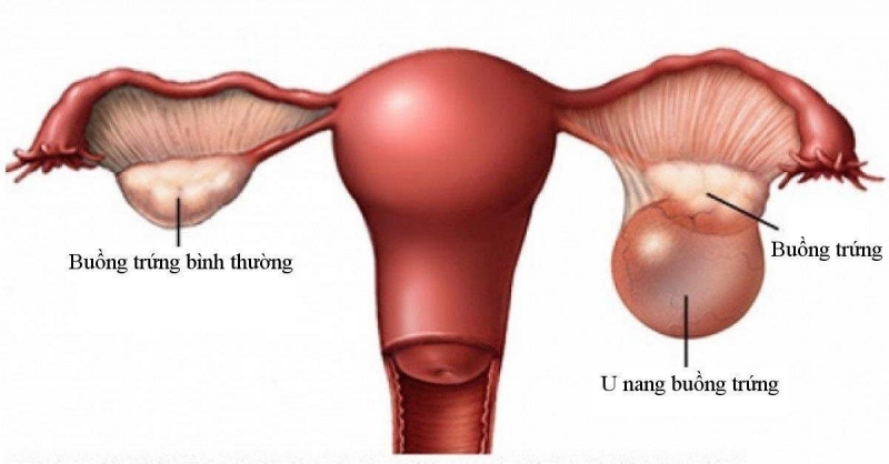 Hình ảnh khối u nang buồng trứng