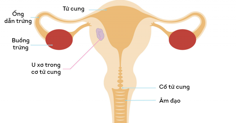 U xơ trong cơ tử cung hình thành và phát triển hoàn toàn bên trong thành tử cung 