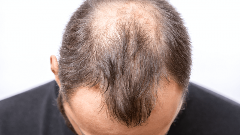 Rụng tóc androgen xuất hiện trước hết ở vùng trán, đỉnh, thái dương