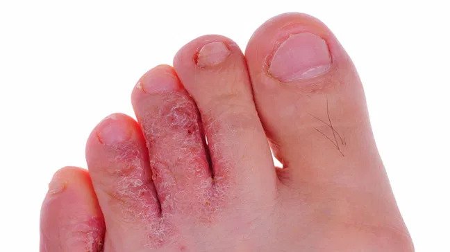 Nấm kẽ chân (nước ăn chân) xuất hiện ở các kẽ ngón, lòng bàn chân, khiến da bong vảy trắng, nền da sưng đỏ