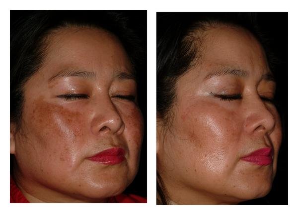 Nghiên cứu của Mexico cho thấy hiệu quả làm sáng da sau 8 tuần sử dụng niacinamide - Ảnh: Researchgate