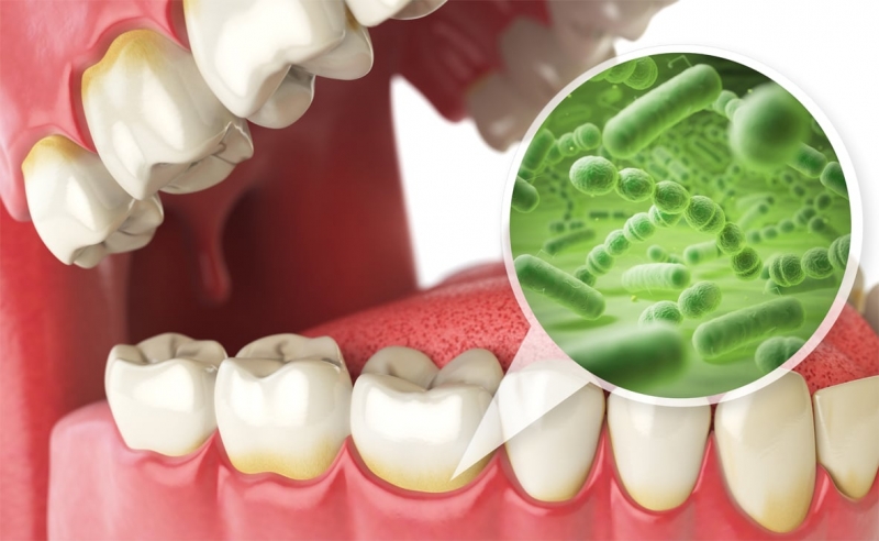 Nước súc miệng góp phần loại bỏ vi khuẩn gây bệnh răng miệng