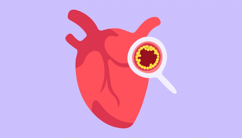Người bị mỡ máu cao cần đề phòng nguy cơ nhồi máu cơ tim