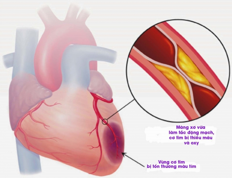 Nhồi máu cơ tim cấp xảy ra khi mảng xơ vữa trong lòng mạch vành bị nứt hoặc vỡ