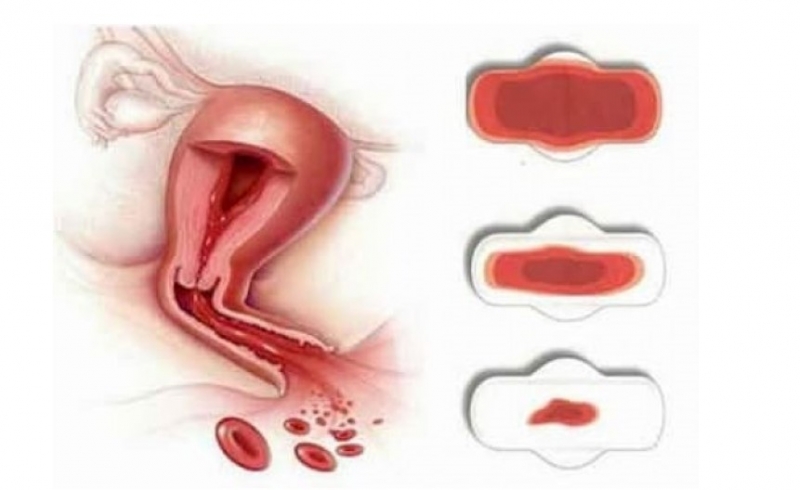 Ra máu nhiều hơn bình thường vào kỳ kinh nguyệt là dấu hiệu điển hình do u xơ tử cung gây ra